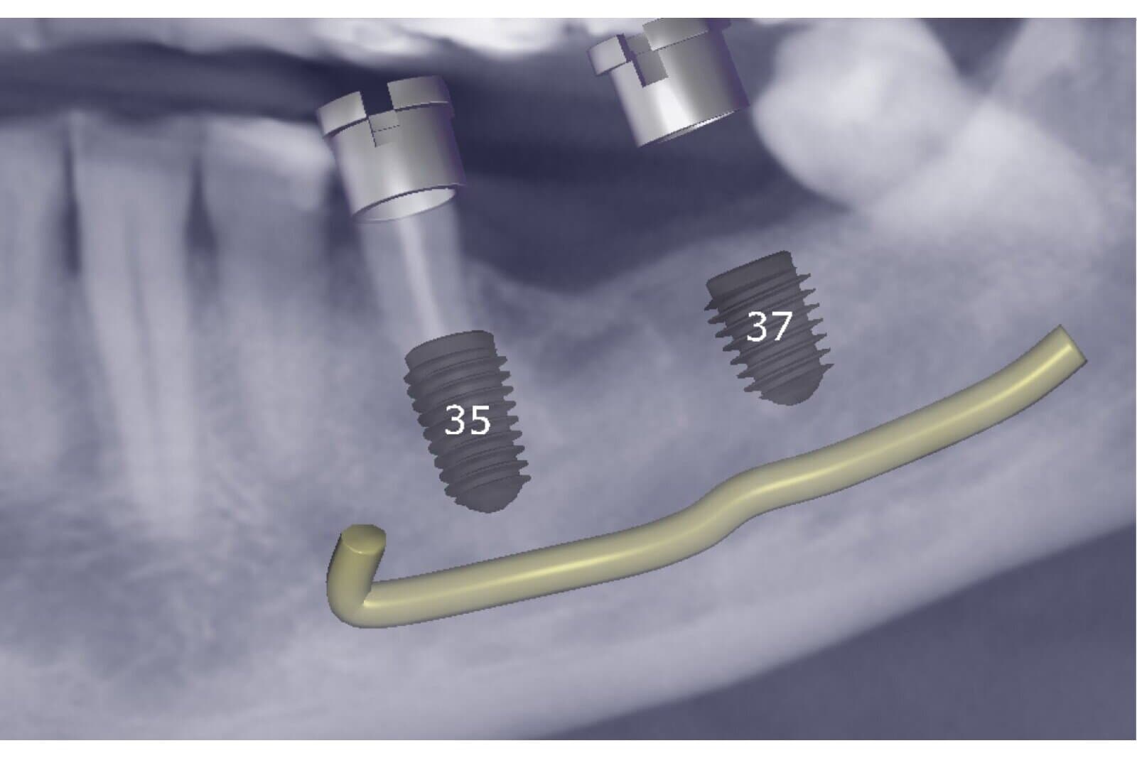Digitale Implantatplanung Regio 35 und 37 mit markiertem Nervverlauf